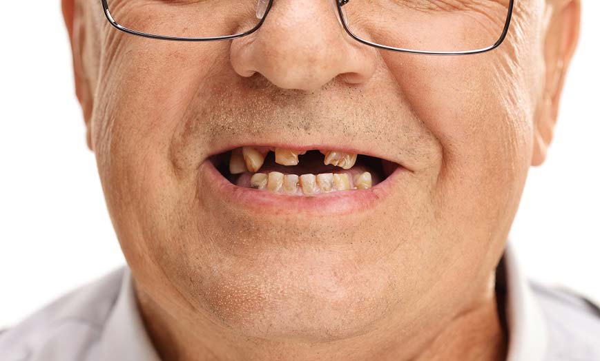 Immediate Dentures - The Concepts Process and Benefits