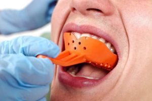 Taking Teeth Impression for Dentures