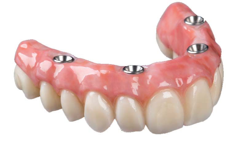 Implant Retained Dentures