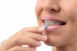 dental hygiene of teeth with braces