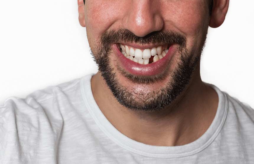 Lost a tooth | Direct-Denture-Care