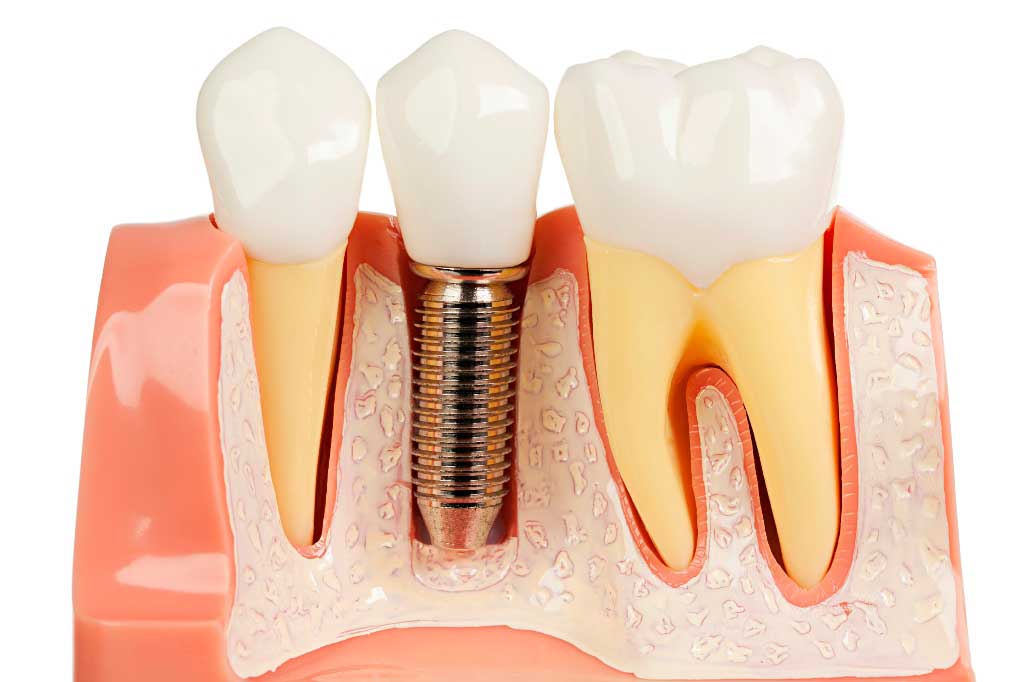 Dental Implants Perth WA