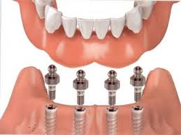 Implant overdentures Denture Clinic Perth