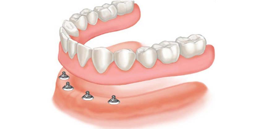 Implant Overdentures