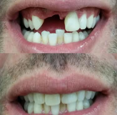 Dental Implants before and After Image