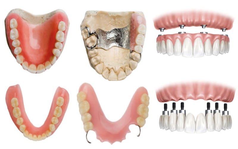 What is the best Denture type for you? Direct Denture Care, Denture Clinic