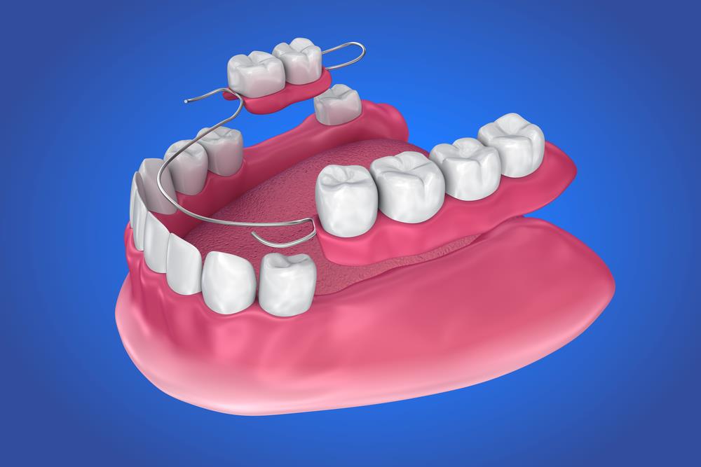 partial dentures